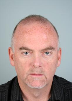 Before Hair Transplant&nbsp;2 Sessions (Areas)